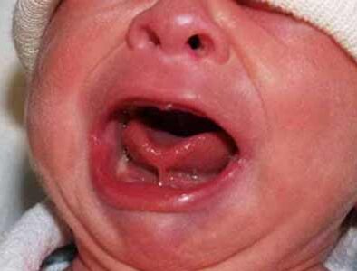 Kondisi Menyusui: Tongue-Tie (Tali lidah Pendek)